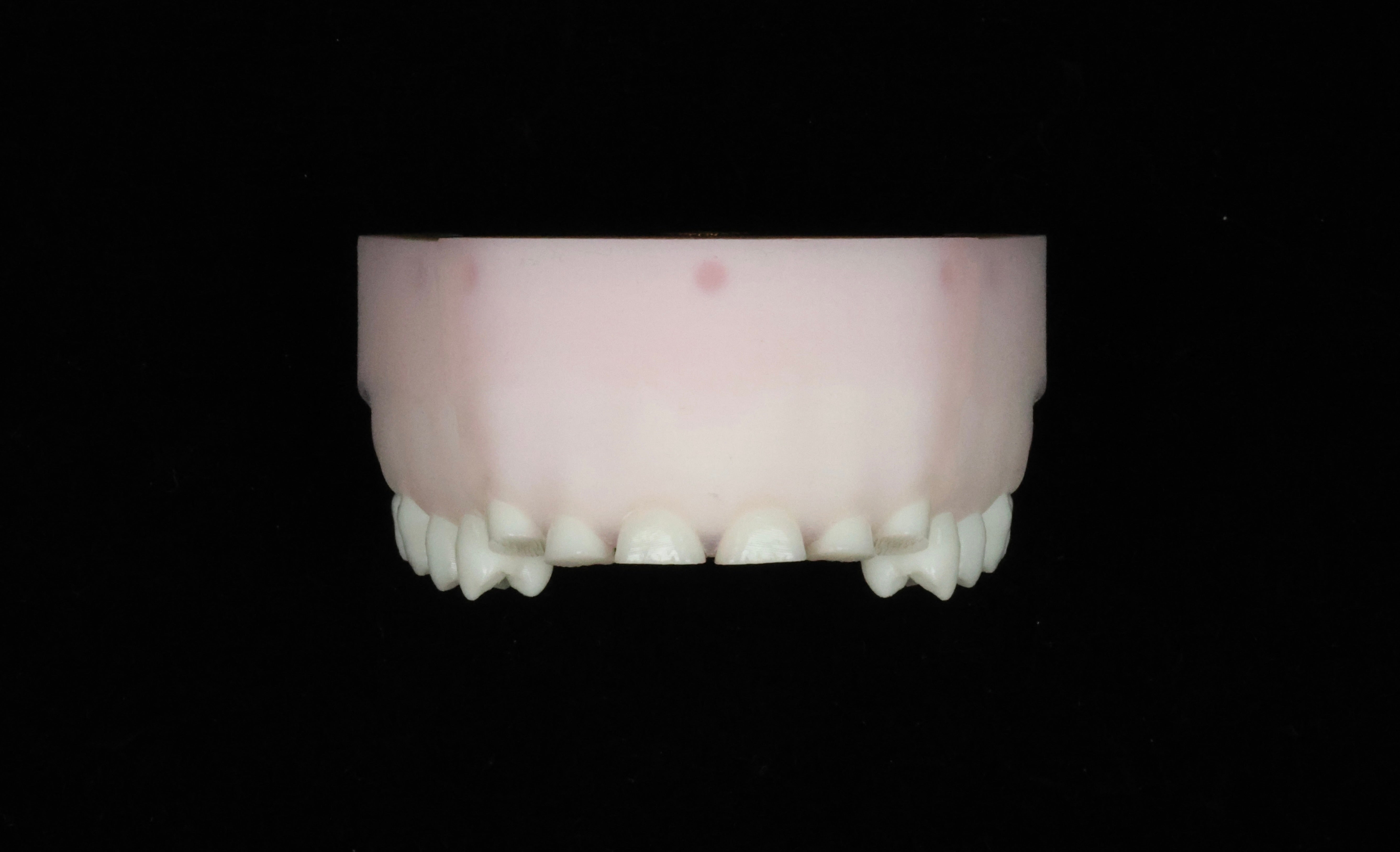 Severe Toothwear Set