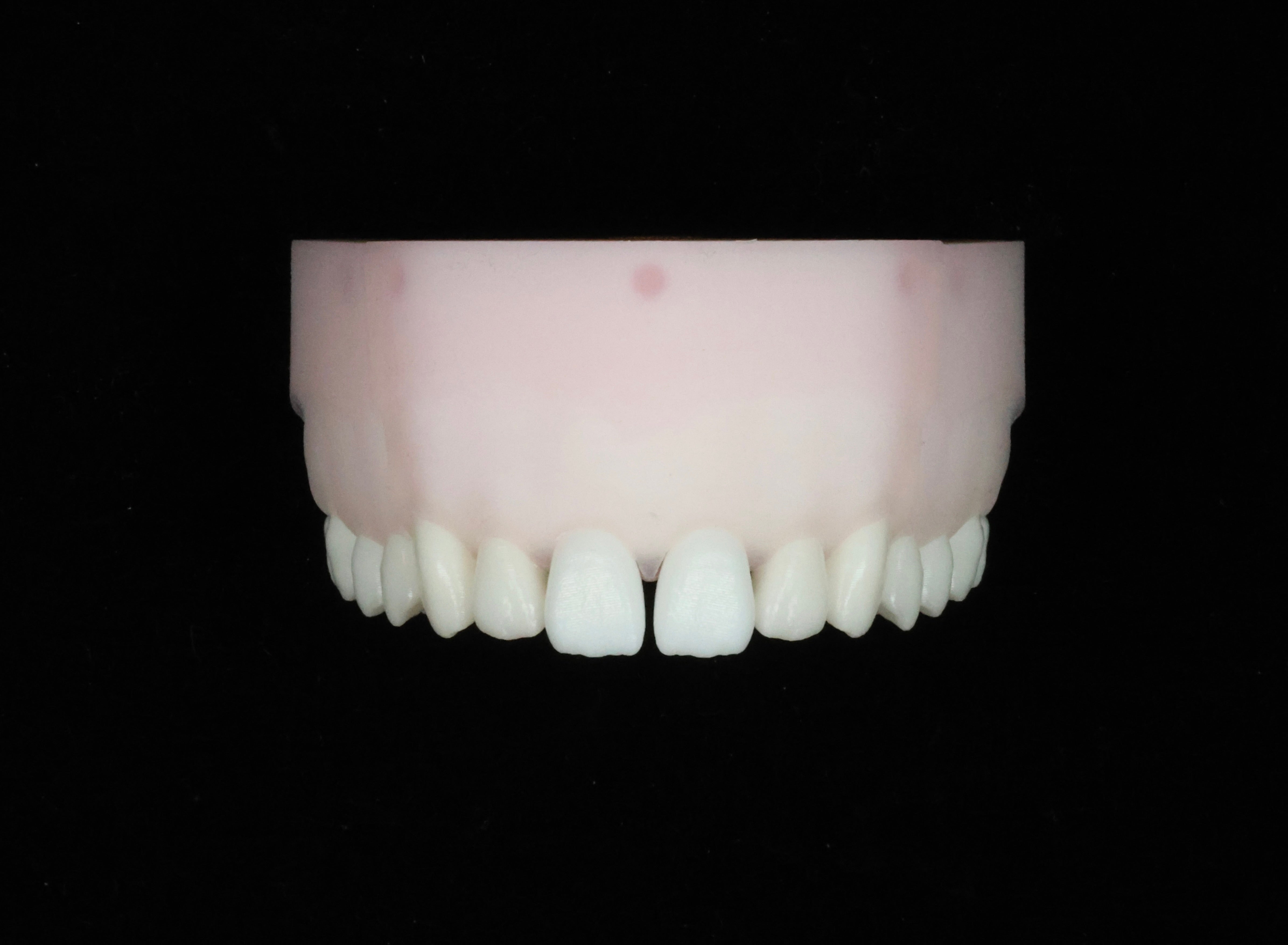 Diastema Closure Set