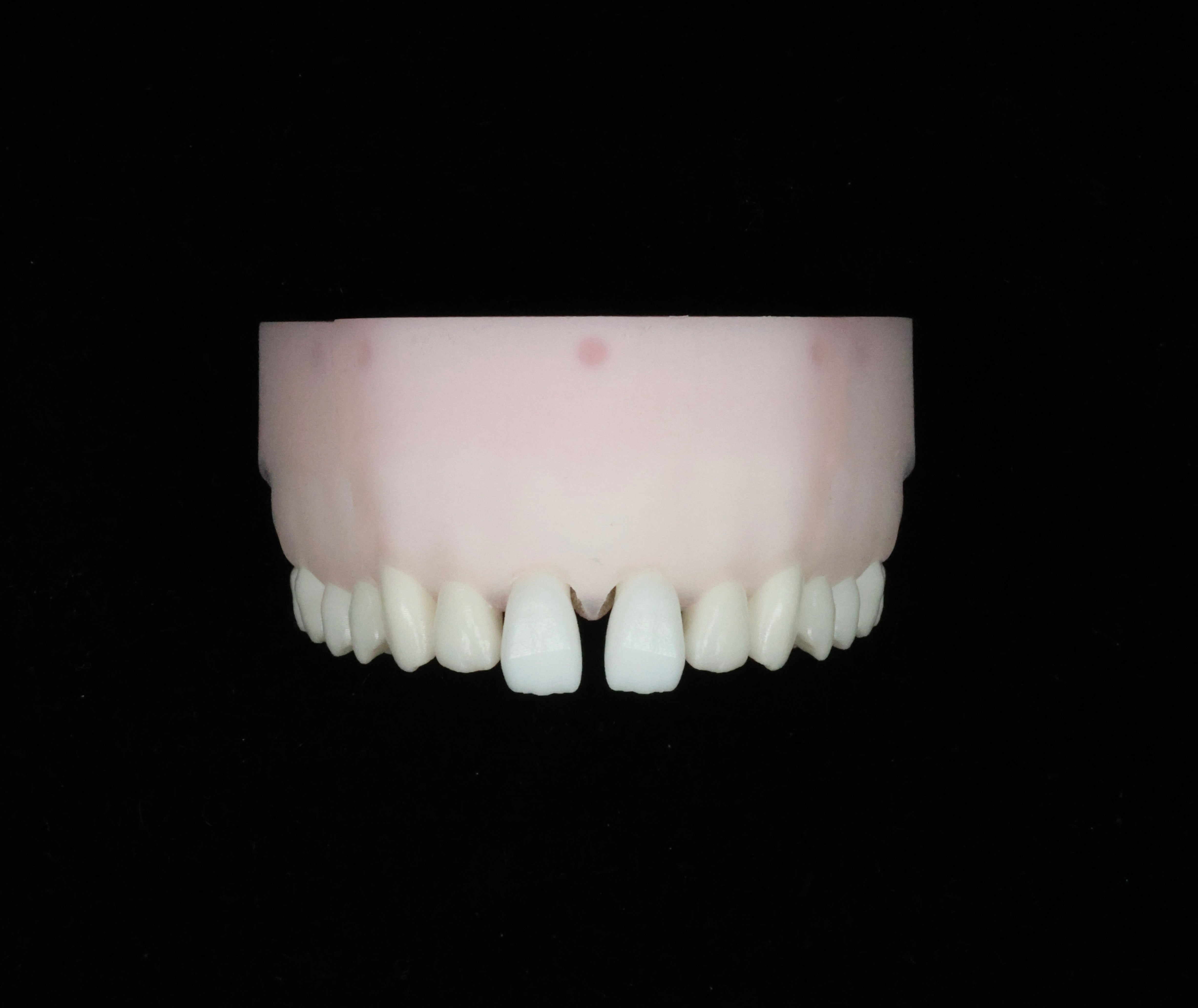 Diastema Closure Set
