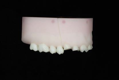 Severe Toothwear Set