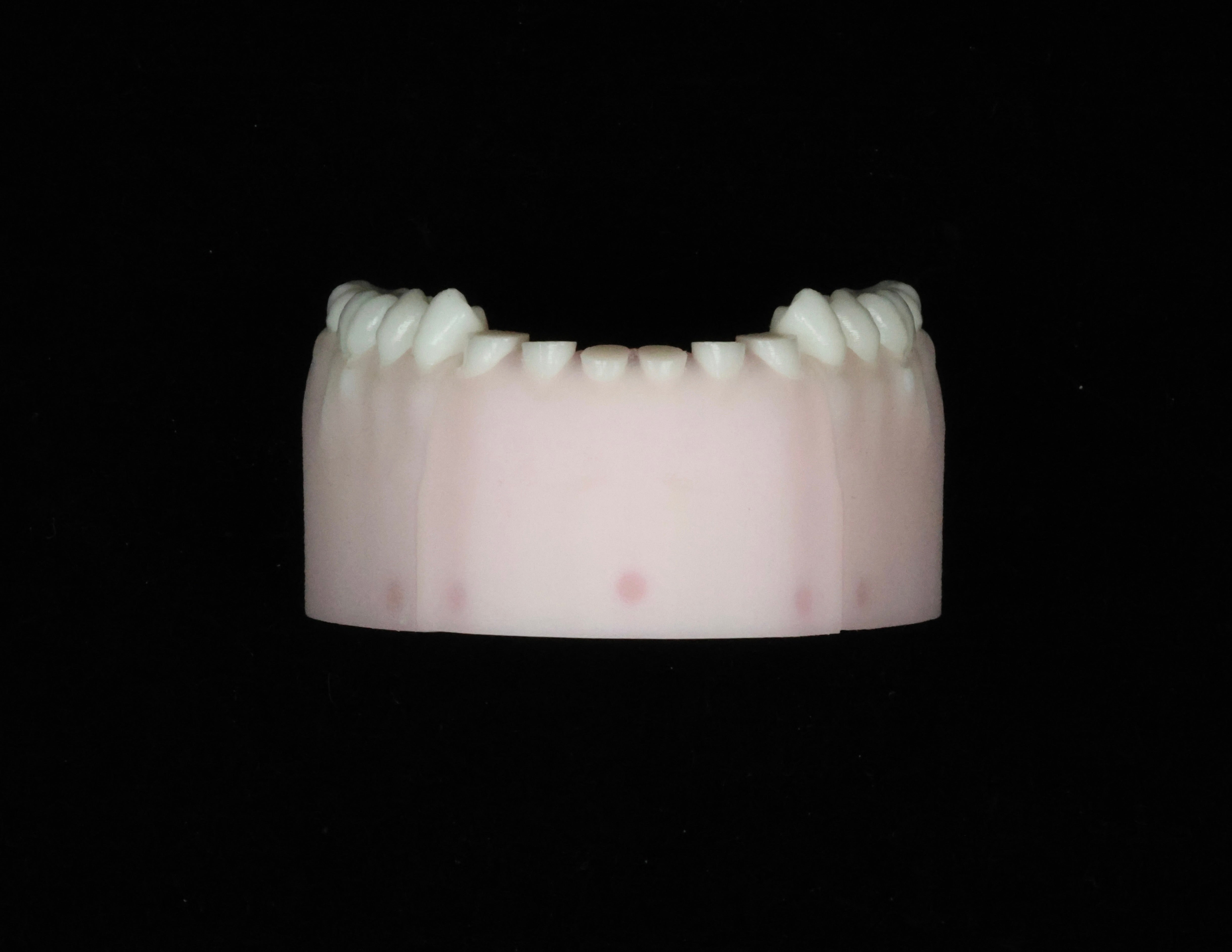 Severe Toothwear Set