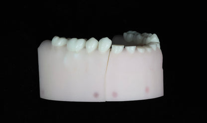 Severe Toothwear Set