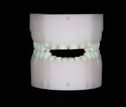 Severe Toothwear Set