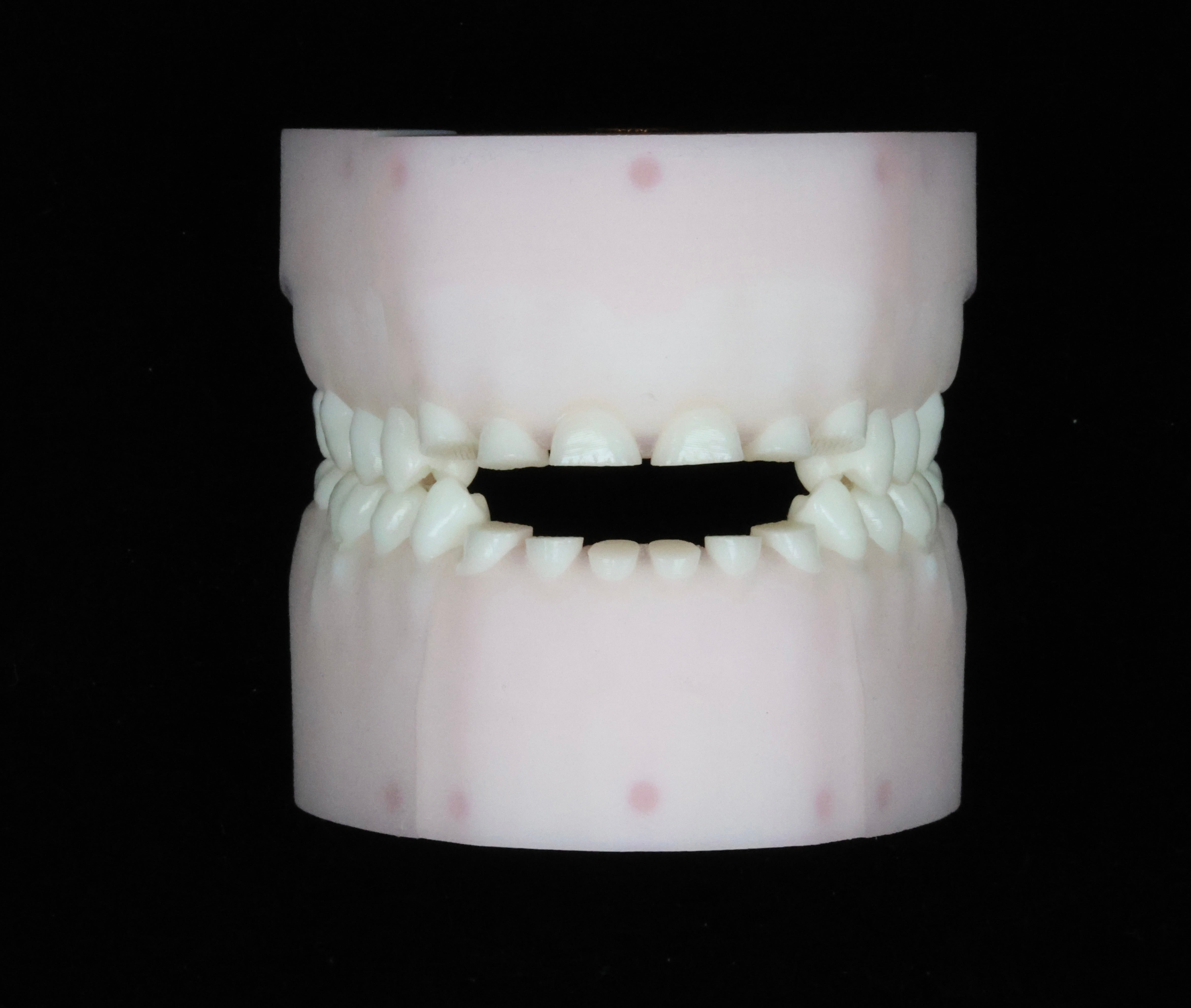 Severe Toothwear Set