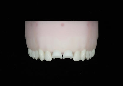Fractured Upper Central Incisors — Class IV Defect Set