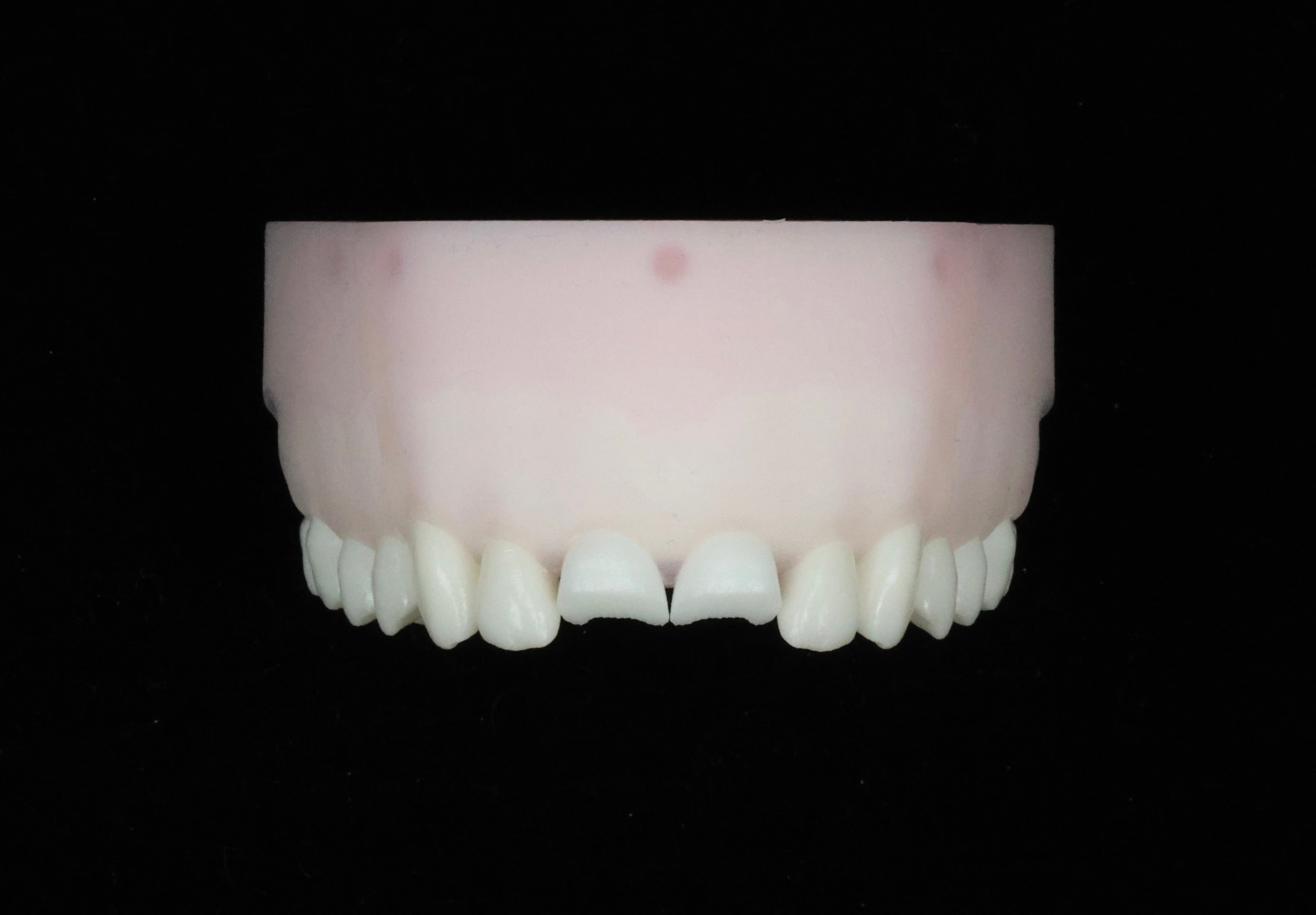 Fractured Upper Central Incisors — Class IV Defect Set
