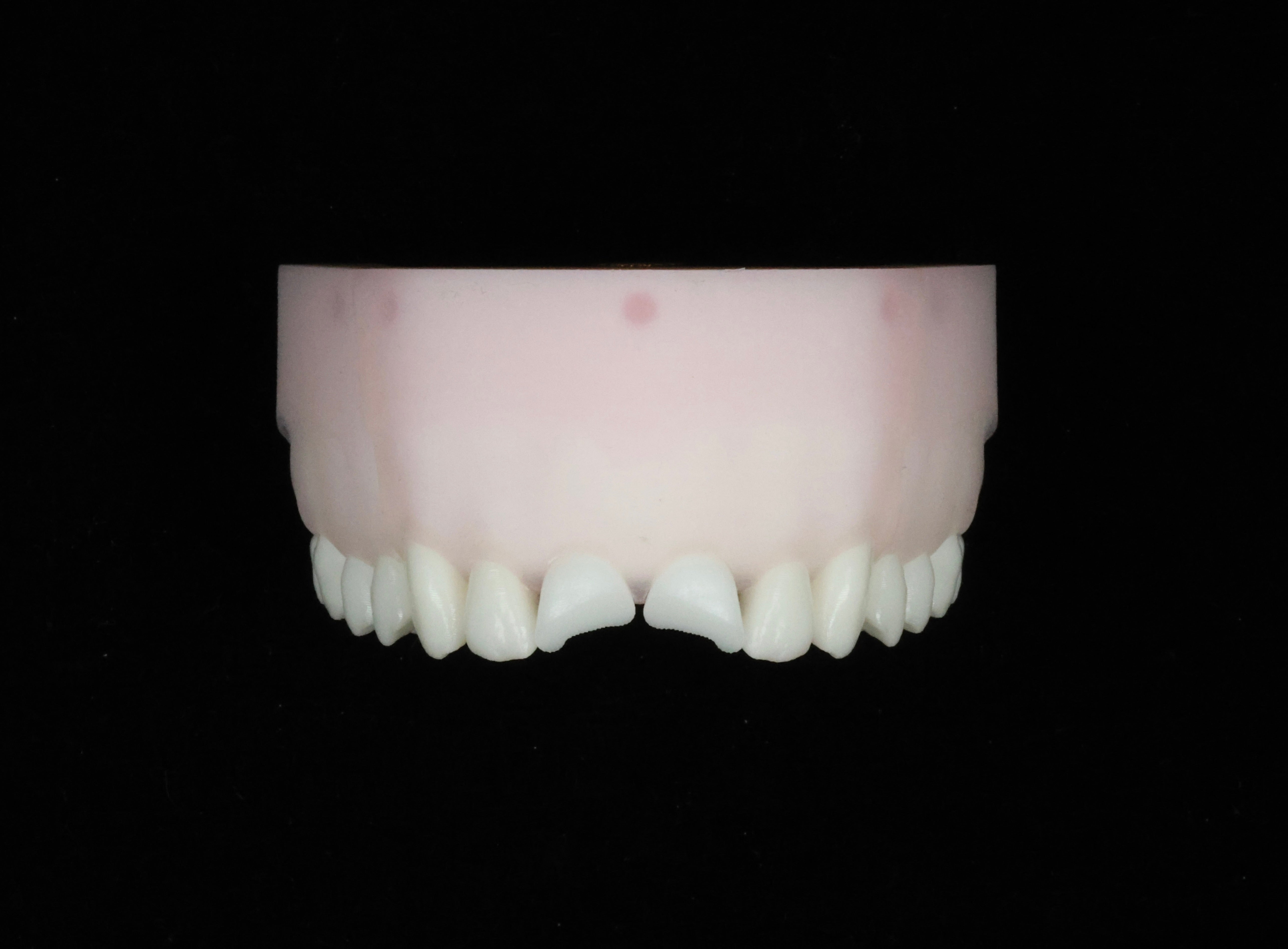 Fractured Upper Central Incisors — Class IV Defect Set