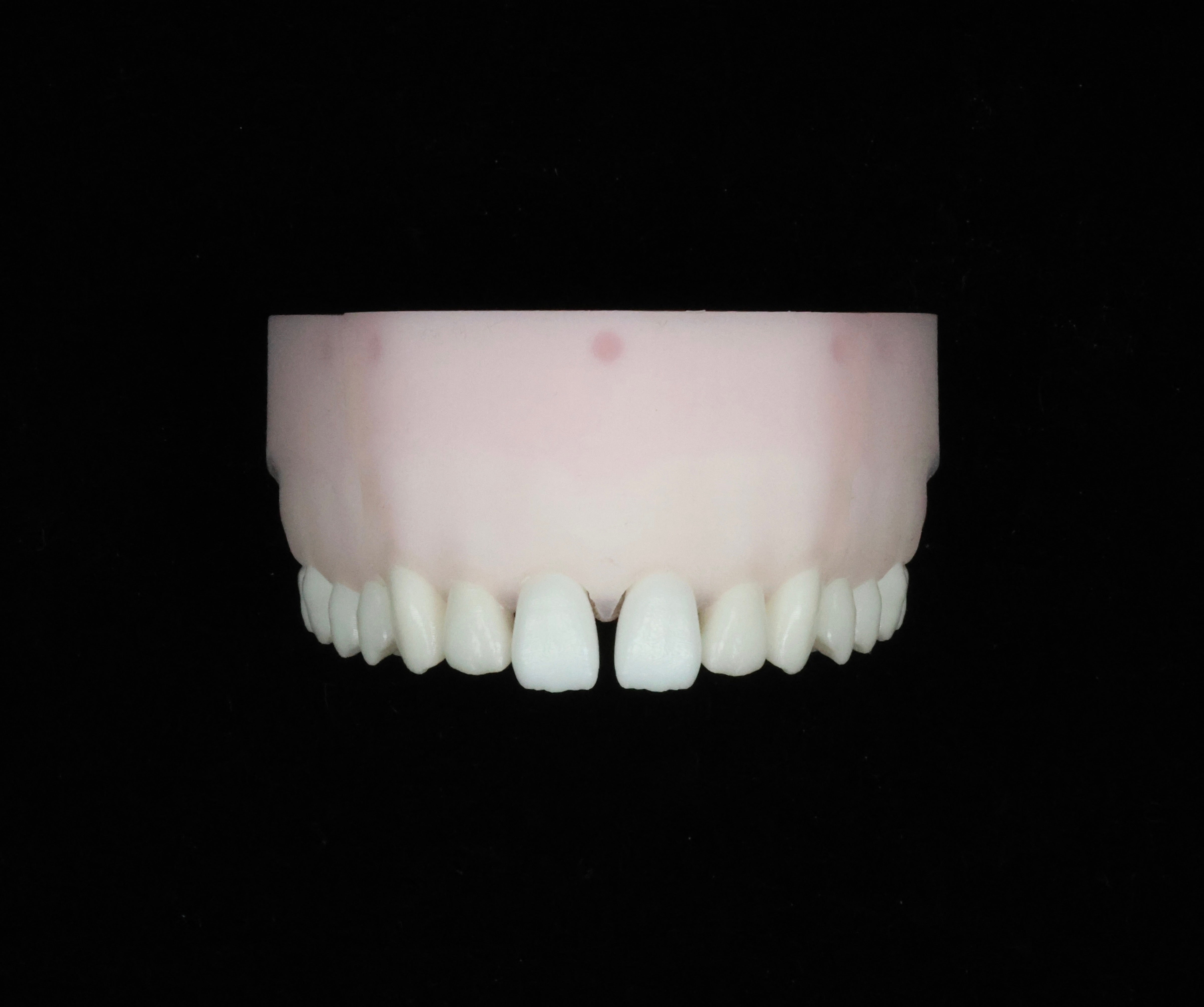 Diastema Closure Set